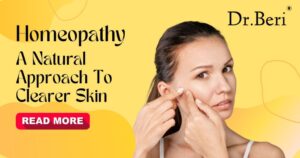 Homeopathic remedies for acne