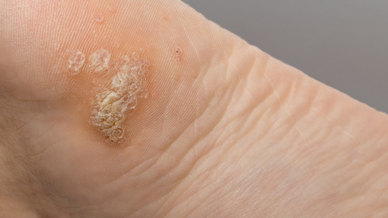 risk factor for warts