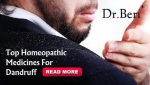Homepathy solutions for dandruff