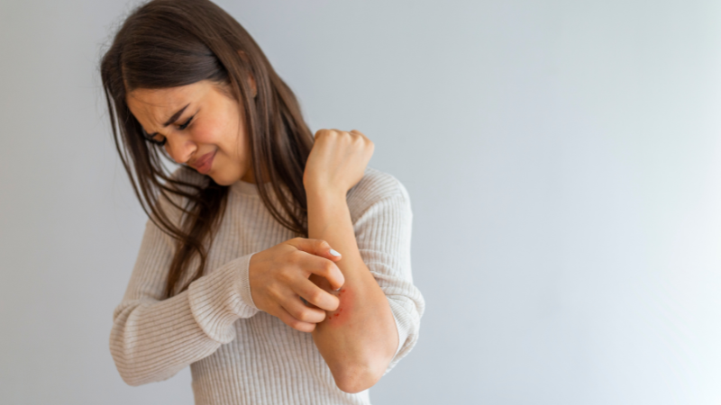 Psoriasis Homeopathic Treatments