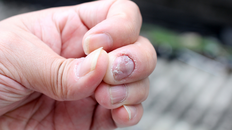 Best homeopathic medicine for Nail Psorisasis 

