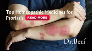 Psoriasis| Homepathy| Solutions
