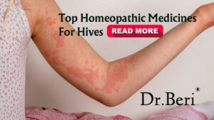 Red, raised hives (urticaria) on skin with distinct borders.