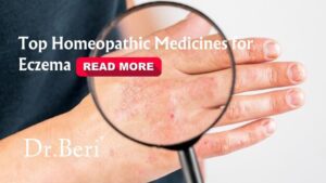 Atopic Dermatitis (Eczema) remedy