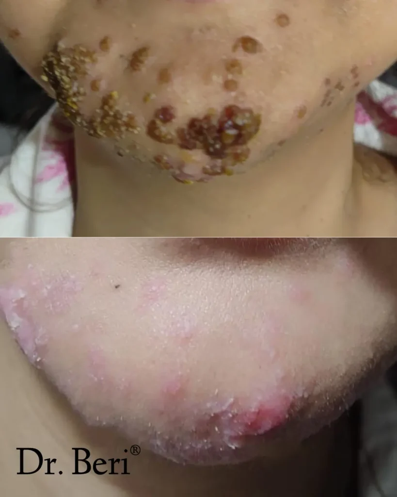 Homeopathy treatment Acne before and after