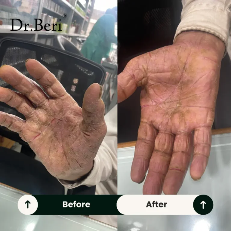 Homeopathy treatment Allergic Dermatitis Fissure