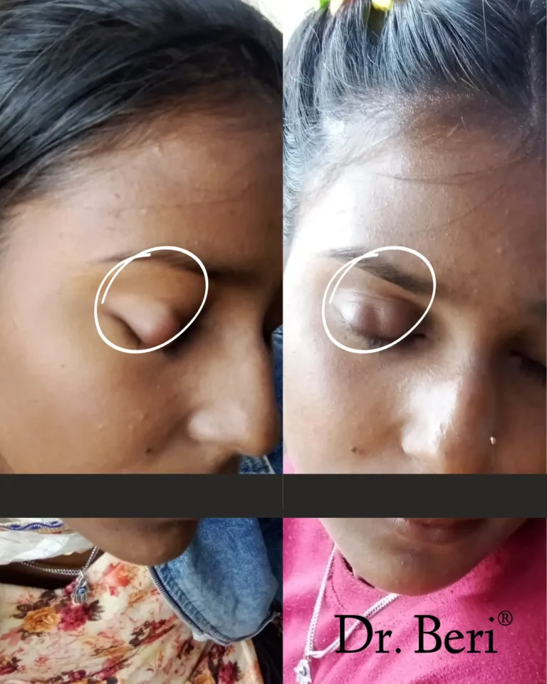 Homeopathy treatment Chalazion before and after