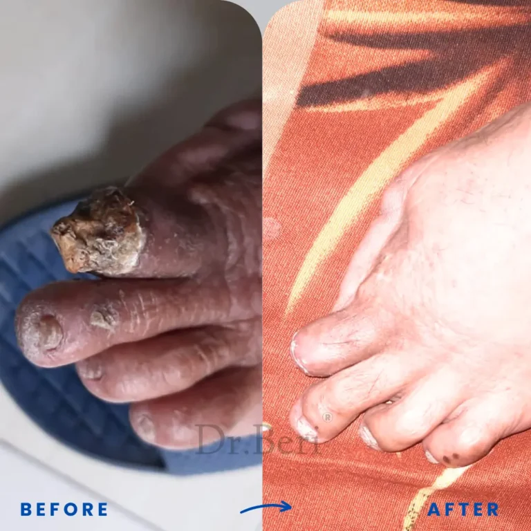 Homeopathy treatment diabetic foot before and after