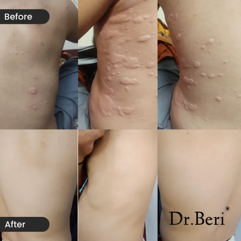 Homeopathy treatment urticaria Before and After