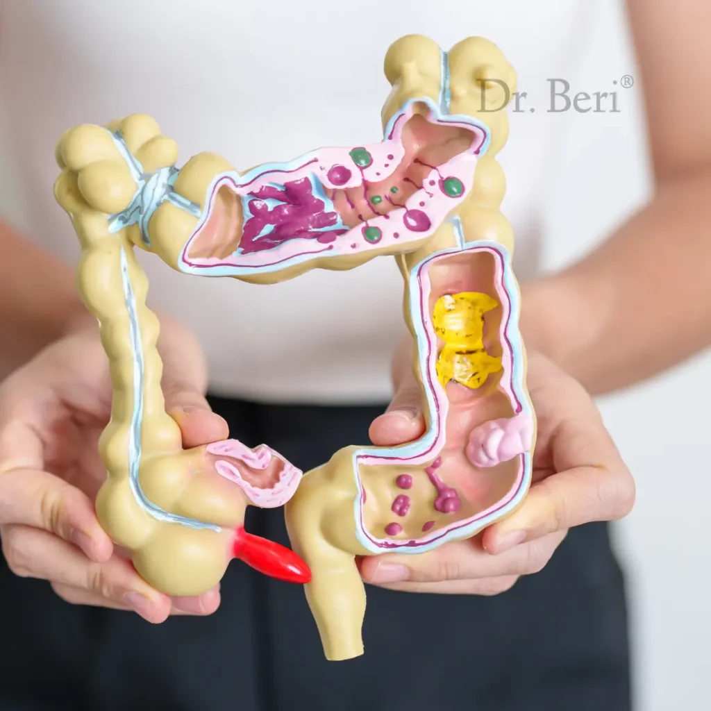 Homeopathic Treatment for IBS (Irritable Bowel Syndrome)