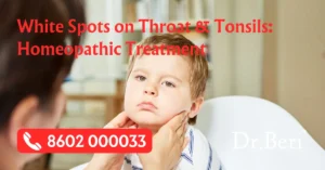 Homeopathy Treatment White Spots