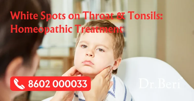 Homeopathy Treatment White Spots